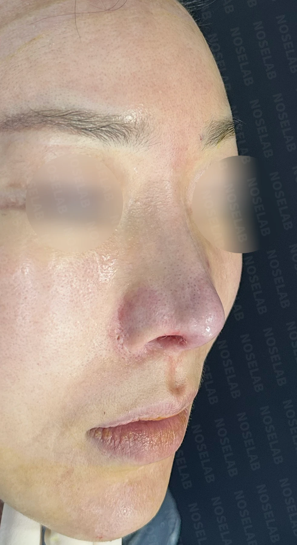 여러 차례 코성형 후 구축 변형을 교정하는 방법 — 수술 직후 0일 정면, 측면, 비스듬한 측면 직후 사진은 부기가 있는 상태로 최종 결과와 다를 수 있습니다.