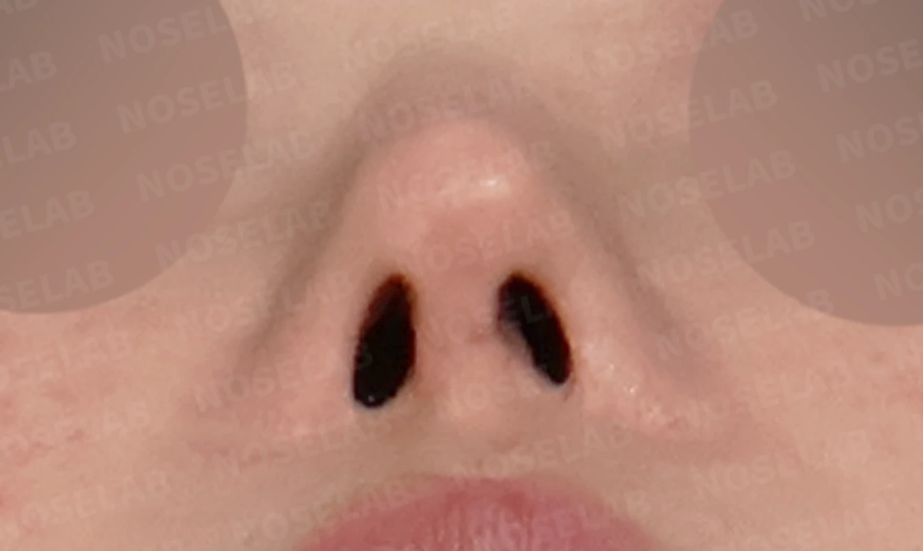 코성형 뒤 코막힘이 더 심해지는 이유, 비중격 재건과 절골 복원은 어떻게 하나 — 수술 전 / 수술 직후 0일 직후 사진은 부기가 있는 상태로 최종 결과와 다를 수 있습니다.
