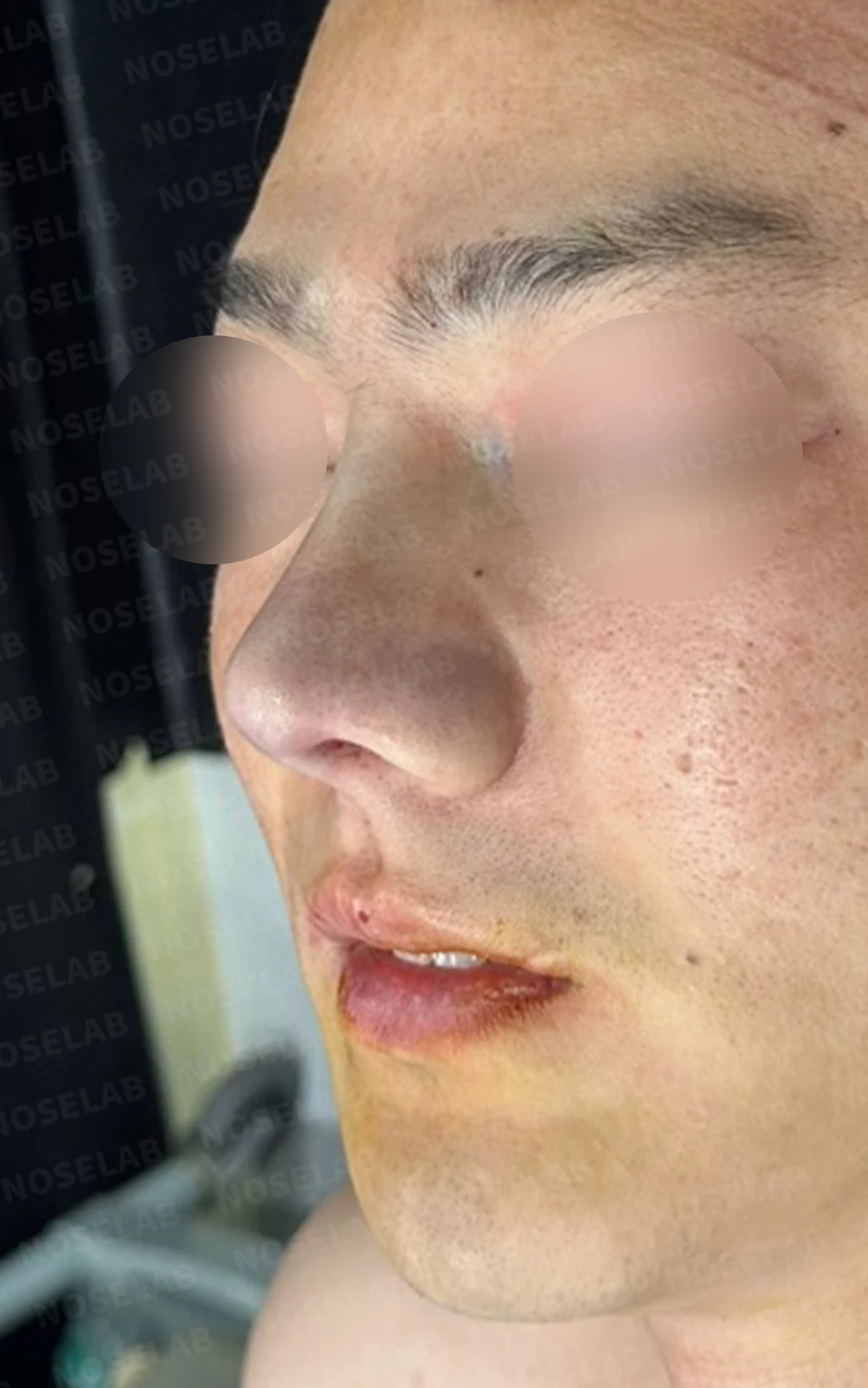 콧구멍 비대칭과 들린 코가 함께 생기는 이유, 늑연골 재건은 어떻게 하나 — 수술 전 / 수술 직후 0일 직후 사진은 부기가 있는 상태로 최종 결과와 다를 수 있습니다.