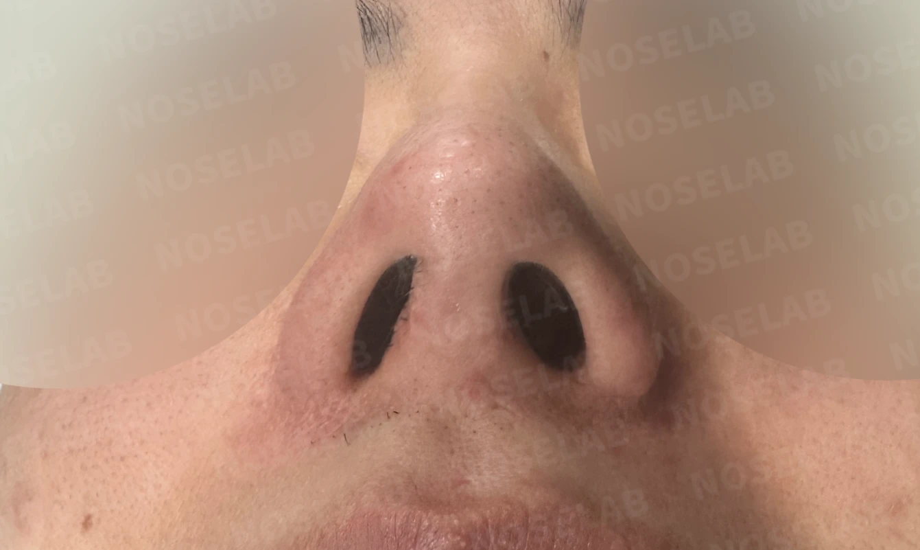 코재수술과 코막힘 교정, 기능과 심미 모두 잡은 비개방 코성형 사례 — 전(좌) 직후(후)