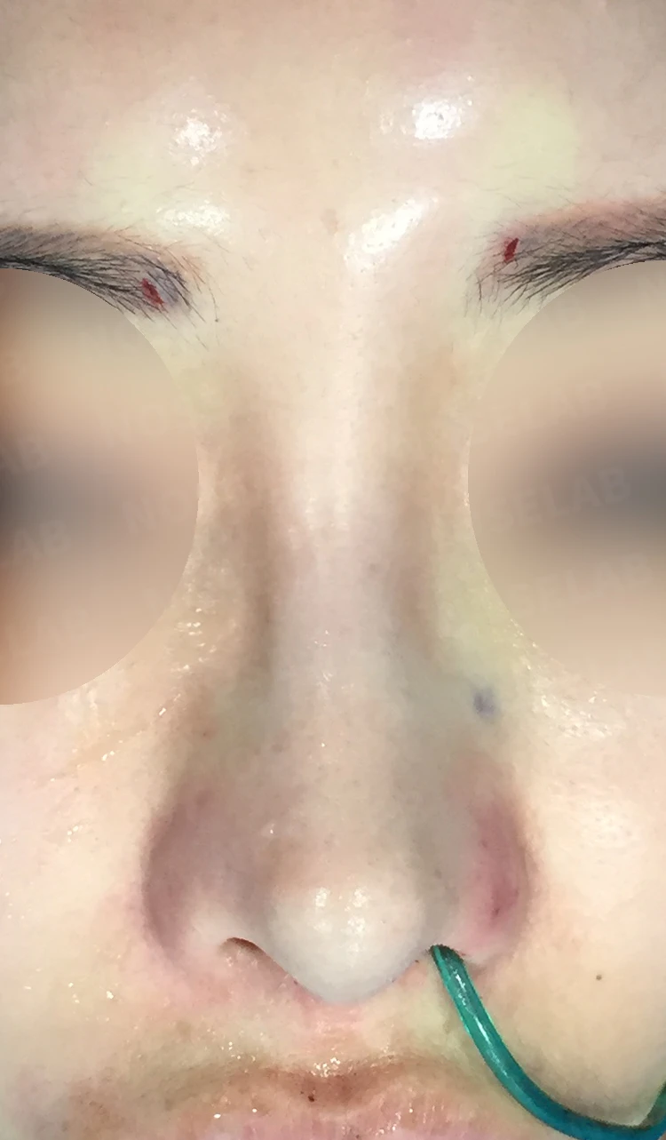 휜코와 콧대·코끝의 자가늑연골 비개방 교정 방법 — 본문 사진 4