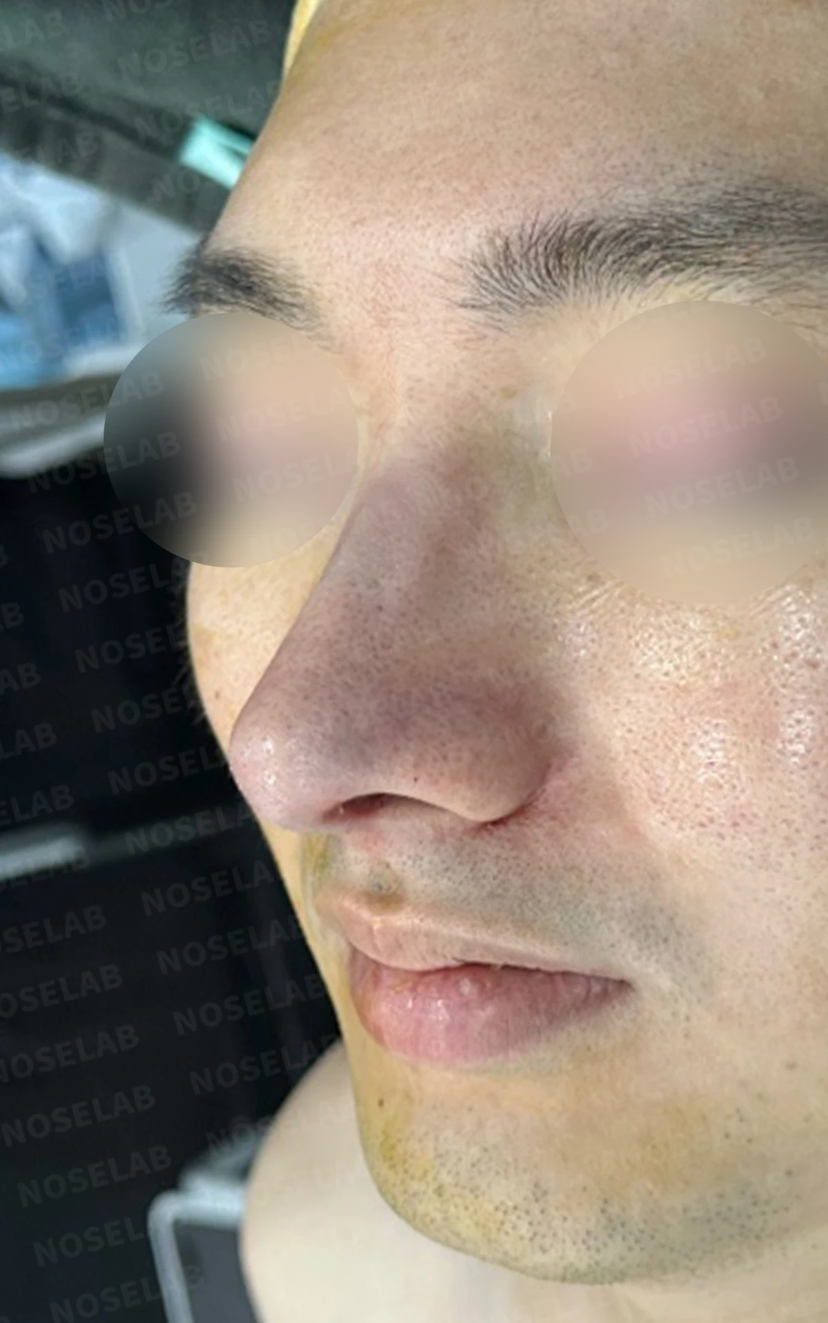 매부리코에 코막힘이 함께 오는 이유, 자가 늑연골만으로 하는 교정 방법 — 수술 직후 0일 정면, 측면, 비스듬한 측면 사진입니다. 직후 사진은 부기가 있는 상태로 최종 결과와 다를 수 있습니다.