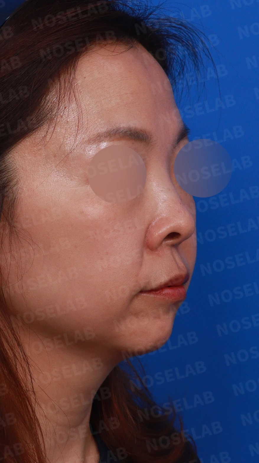 들창코에서 콧구멍이 많이 보이는 이유, 코끝 위치 교정은 어떻게 하나 — 디자인 상담 우측 비스듬한 측면, 측면, 비공 사진