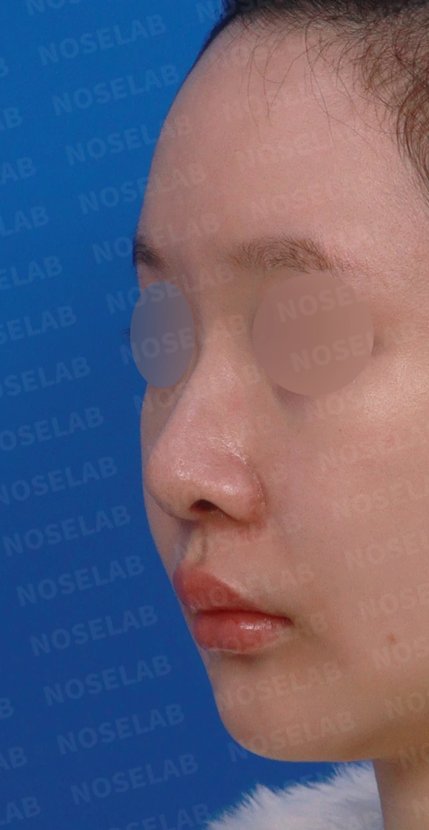 절골 부위가 과하게 깎이면 코가 왜 휘어 보이는가, 코뼈 복원과 코끝 재건 — 디자인 상담 정면, 좌측 측면, 비스듬한 측면 사진입니다