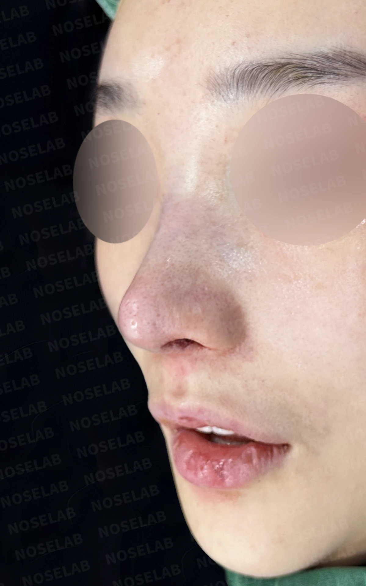 휘어진 코와 퍼진 코끝, 자가늑연골로 세련된 직반라인 완성한 코재수술 — 직후 정면, 비스듬한 측면, 측면 사진입니다.