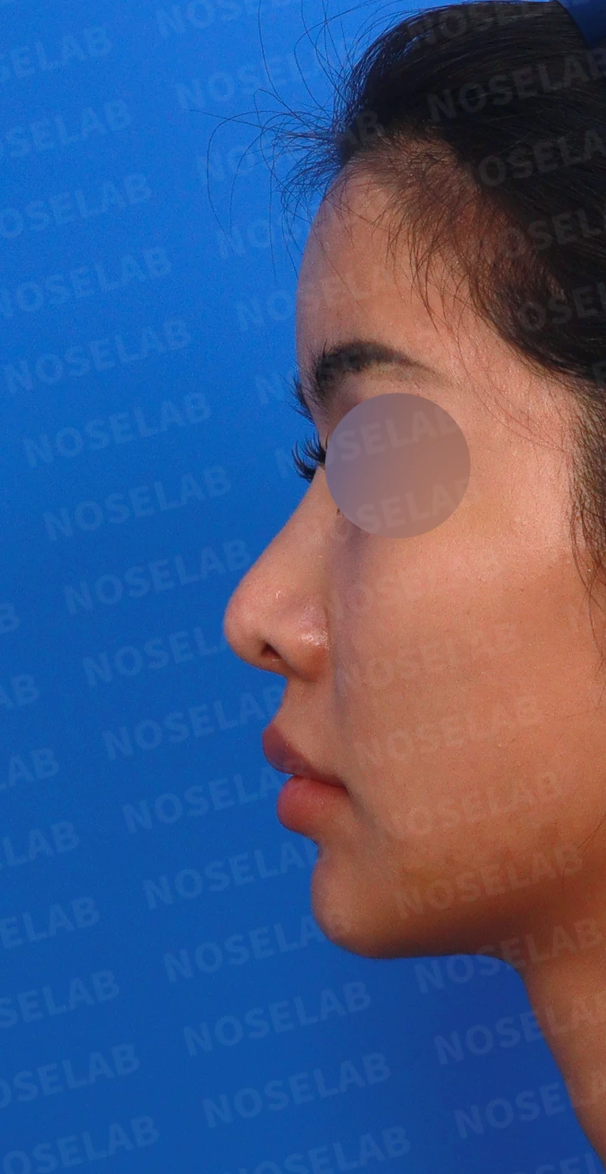 코성형 뒤 코끝이 처지고 웃을 때 퍼지는 이유, 이물질 제거와 코끝 교정 방법 — 디자인 상담 정면, 좌측 측면, 비스듬한 측면 사진입니다.