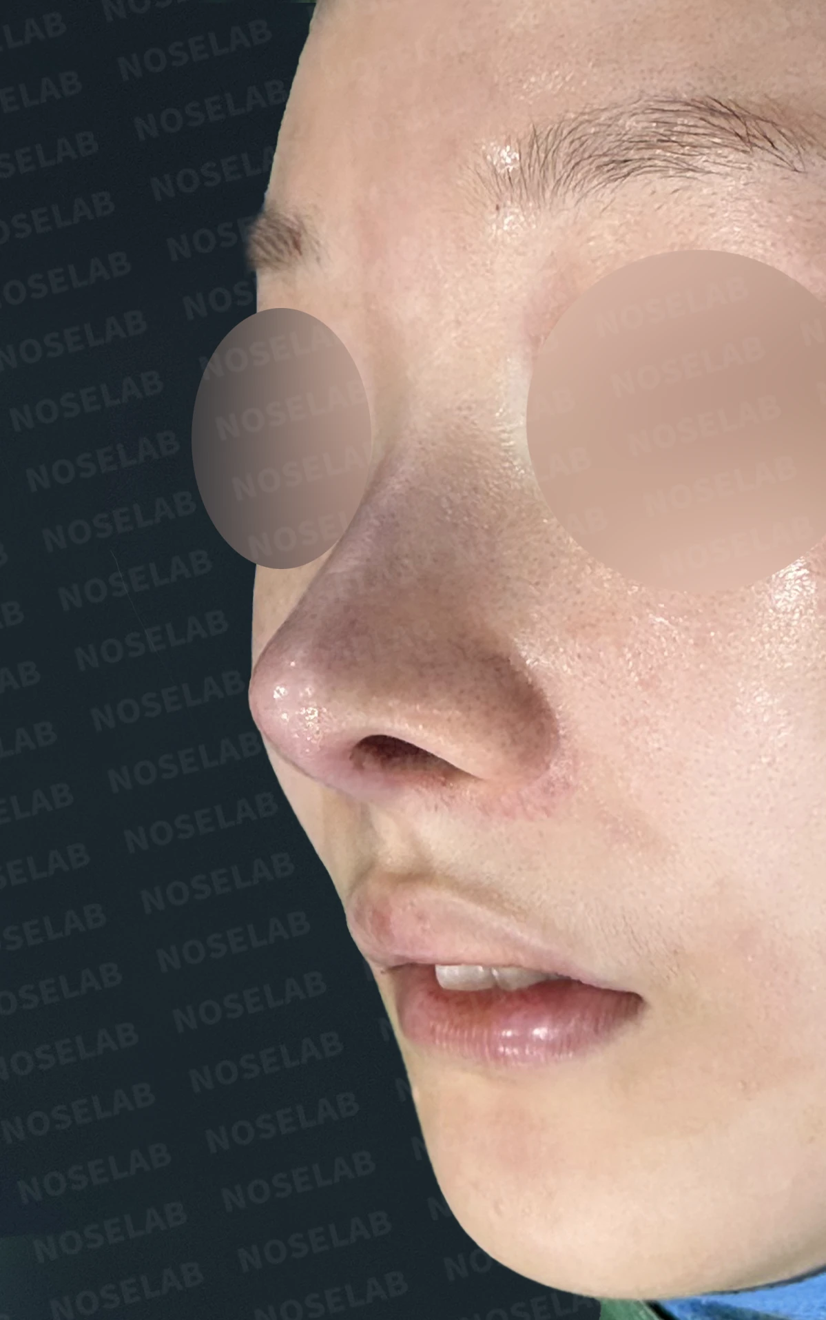 절골 부위가 과하게 깎이면 코가 왜 휘어 보이는가, 코뼈 복원과 코끝 재건 — 수술 전 / 수술 직후 0일 직후 사진은 부기가 있는 상태로 최종 결과와 다를 수 있습니다.