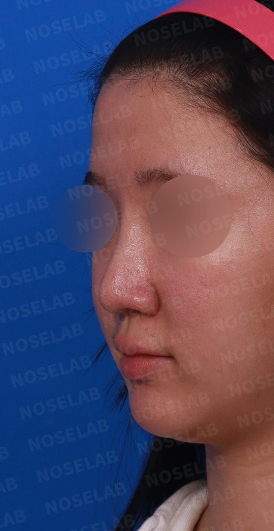 비중격 연골이 손상되면 코끝이 처지고 비주가 함몰되는 이유 — 디자인 상담 정면, 비스듬한 측면 사진, 좌측 측면