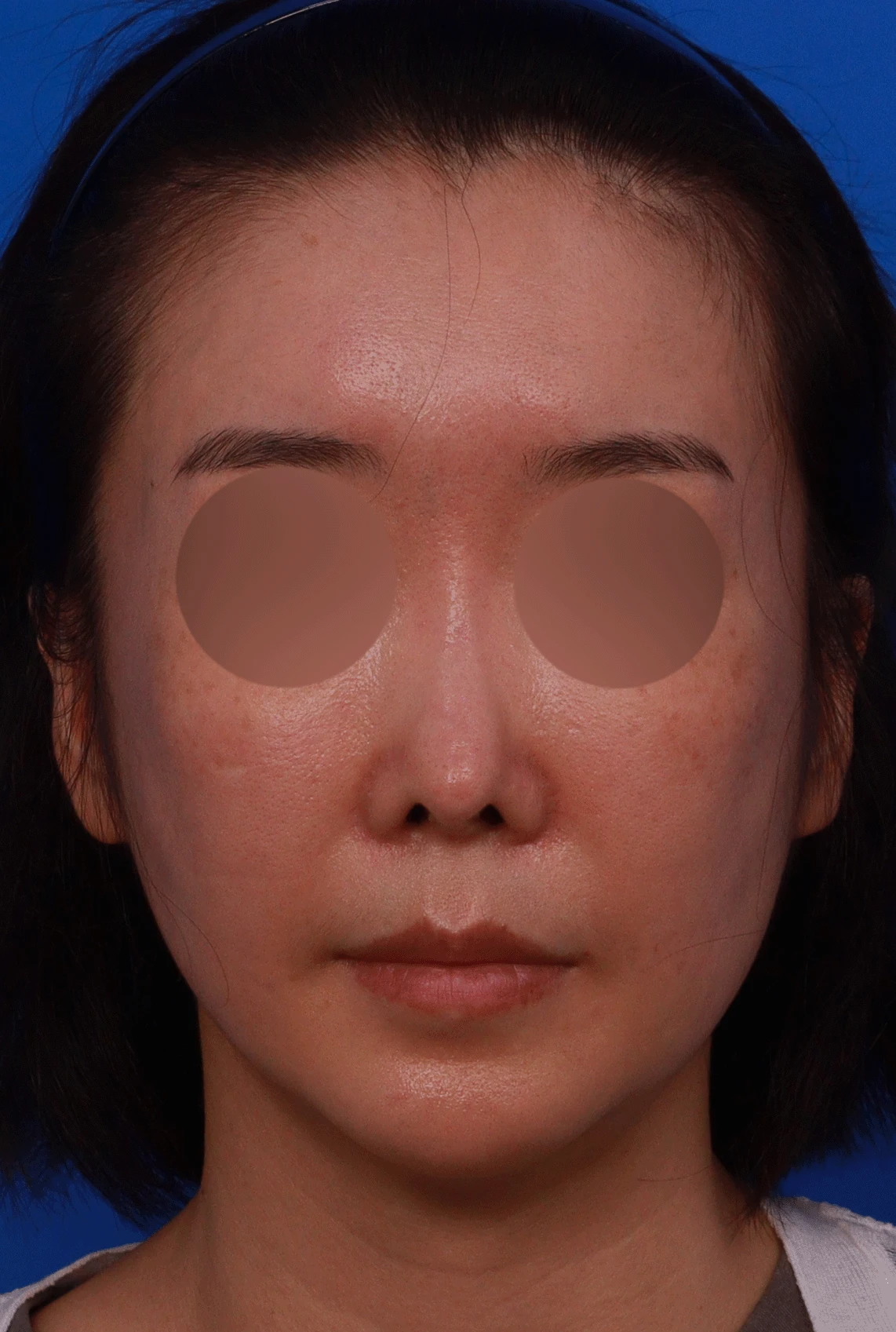 반복된 코재수술 뒤 안장코와 비밸브 협착이 생기는 이유, 전체 재건은 어떻게 하나 — 수술전 디자인 상담 정면 , 좌측 비스듬한 측면 , 측면 사진입니다.