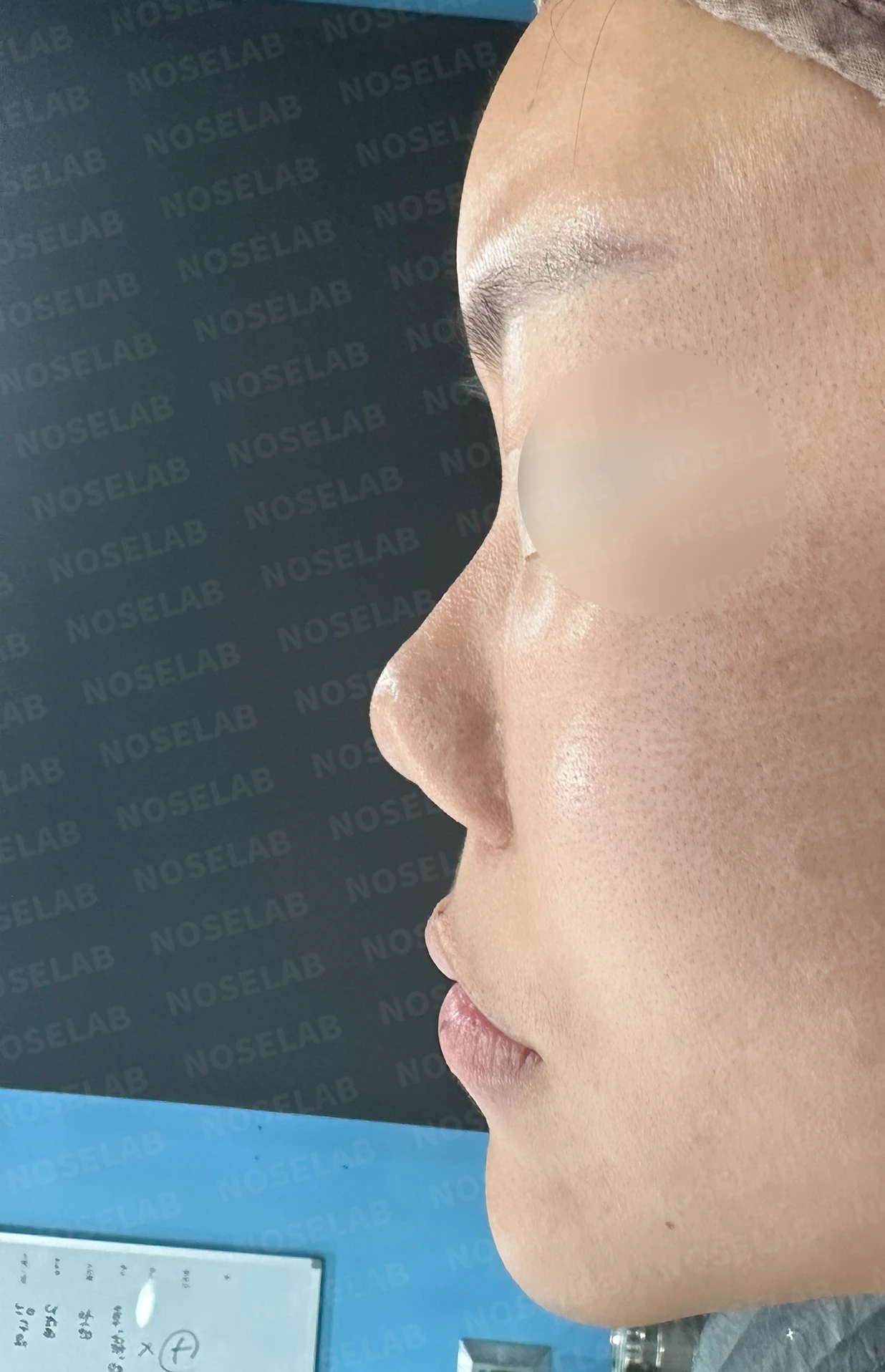 코성형 뒤 감염이 반복되는 이유, 염증 치료와 단계적 재건은 어떻게 하나 — 수술 전 / 수술 직후 0일 직후 사진은 부기가 있는 상태로 최종 결과와 다를 수 있습니다.