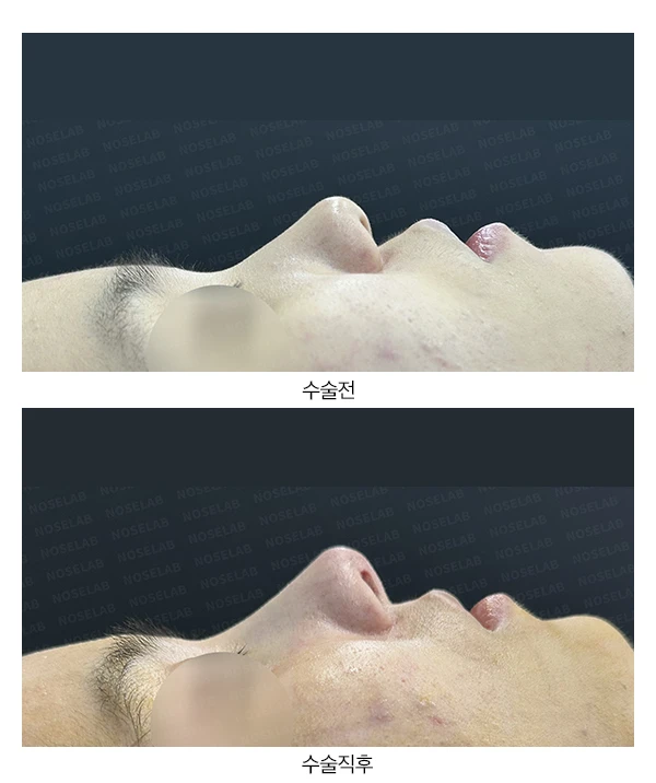 뭉툭하고 퍼진 코의 교정 방법 — 전후 비교