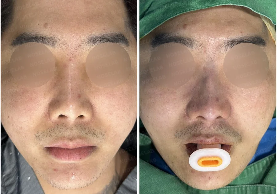 휜코 교정과 비공 비대칭, 자가늑연골로 바로잡은 코재수술 — 전후 비교