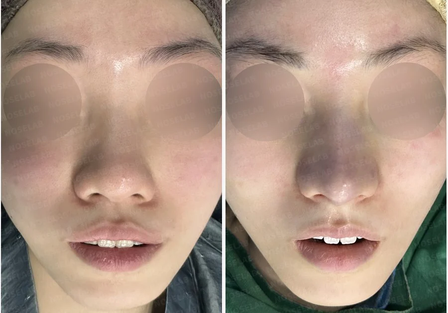 복코와 주먹코, 자가늑연골로 얄쌍하고 여성스러운 코 완성 — 전후 비교