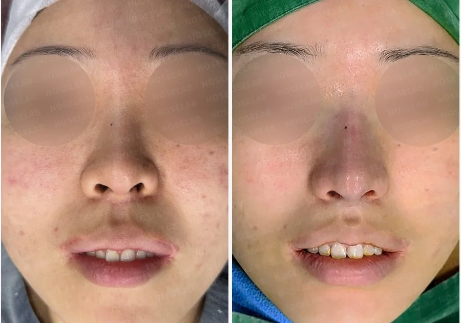 들린 코와 돌출입 개선, 자가늑연골로 화려한 직반라인 완성 — 전후 비교