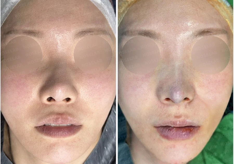 들린 코와 휜 코, 기증늑연골로 안전하게 교정한 무보형물 코재수술 — 전후 비교