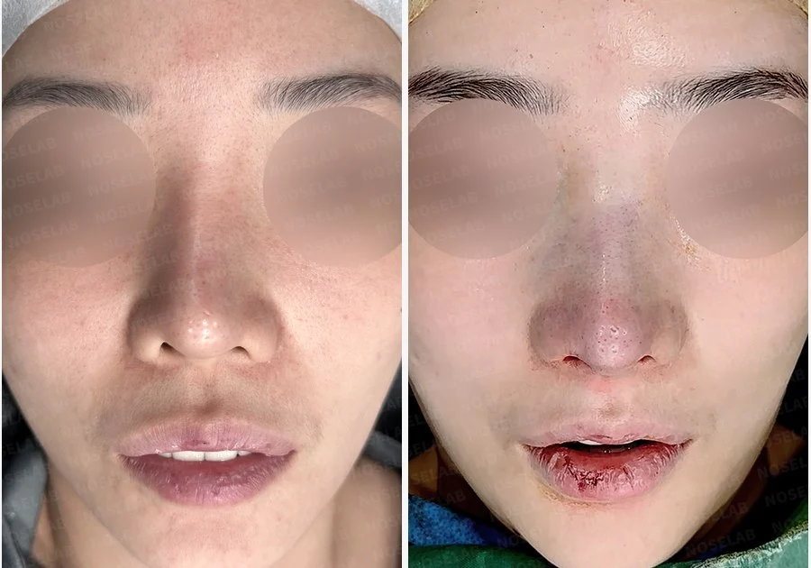 휘어진 코와 퍼진 코끝, 자가늑연골로 세련된 직반라인 완성한 코재수술 — 전후 비교