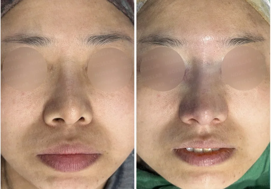 비공 비대칭과 휘어진 코, 자가늑연골 재건으로 교정한 코재수술 — 전후 비교