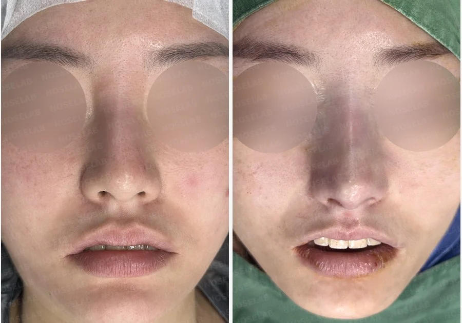 매부리코 교정, 자가늑연골로 자연스러운 코 라인 완성 — 전후 비교