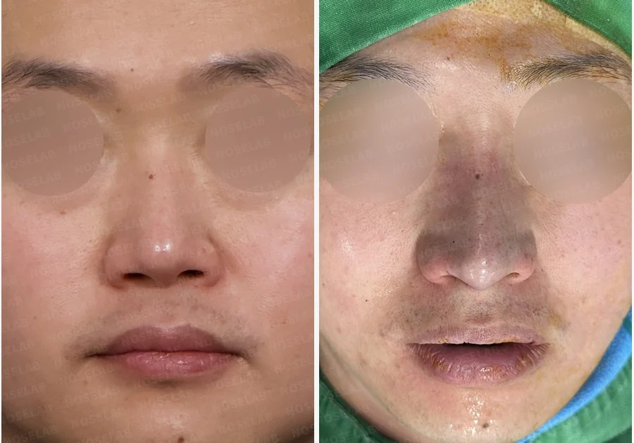 코막힘과 휘어진 비중격, 자가늑연골로 기능과 모양을 동시에 개선 — 전후 비교