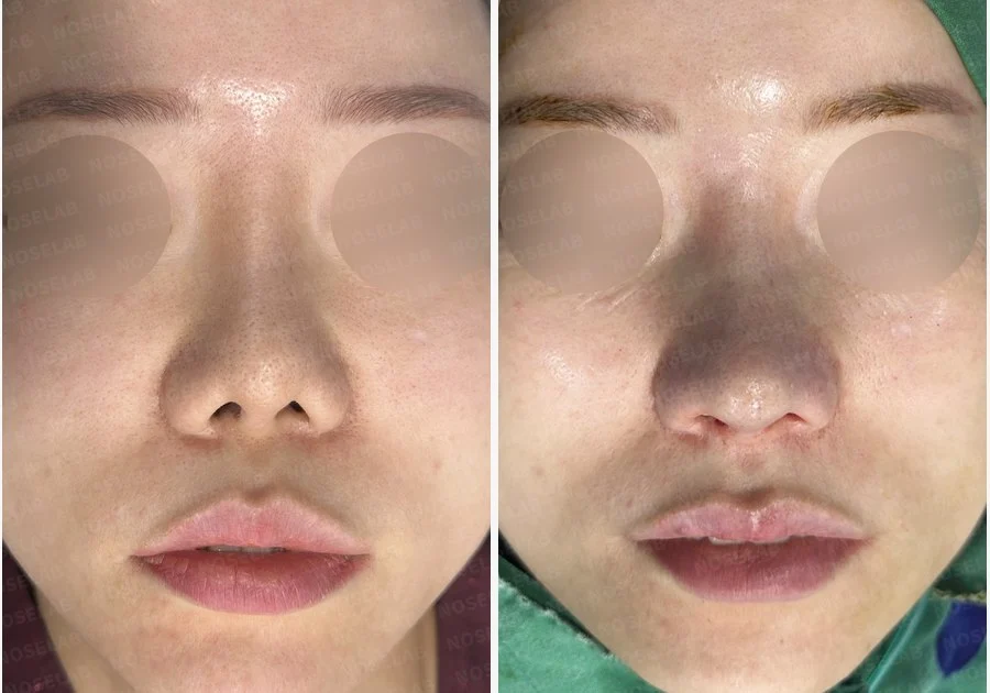 짧은 코와 복코, 자가늑연골로 세련되게 교정한 코재수술 — 전후 비교