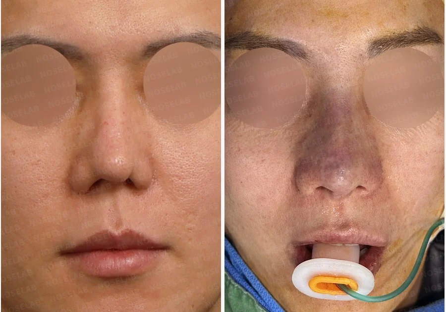 여러 차례 코재수술 후 구축 변형, 자가늑연골로 재건한 사례 — 전후 비교