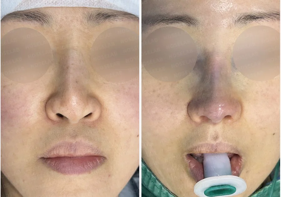 보형물 비침과 용코, 자가늑연골로 안전하게 교정한 코재수술 — 전후 비교