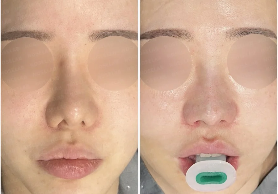긴 코와 비공 비대칭, 자가늑연골로 자연스럽게 교정한 코재수술 — 전후 비교