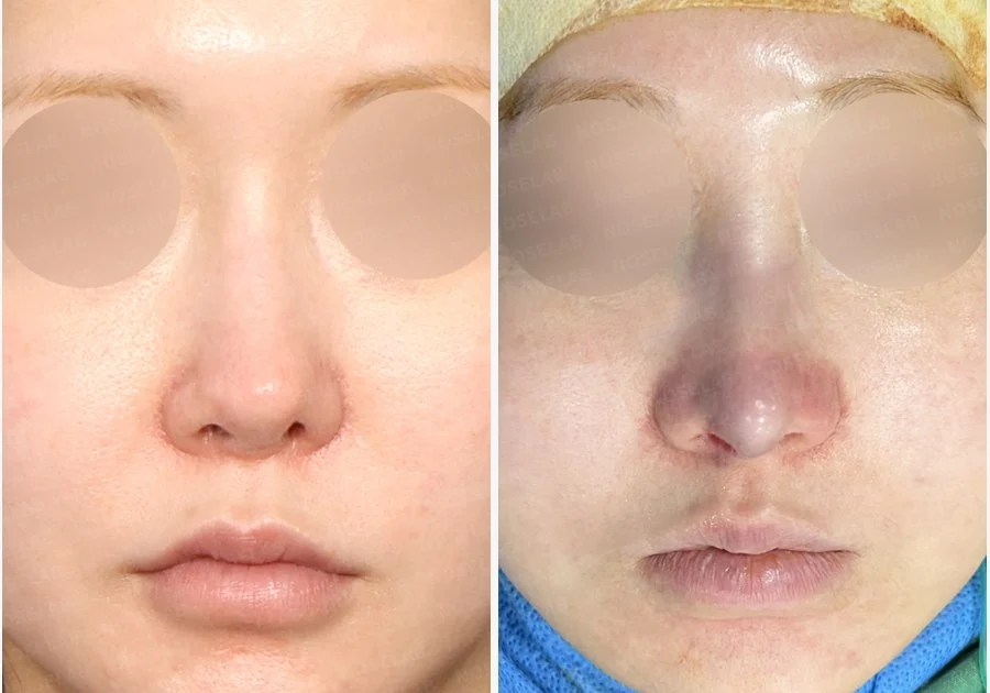 휜코와 비공 비대칭 자가늑연골로 재건한 코재수술 — 전후 비교