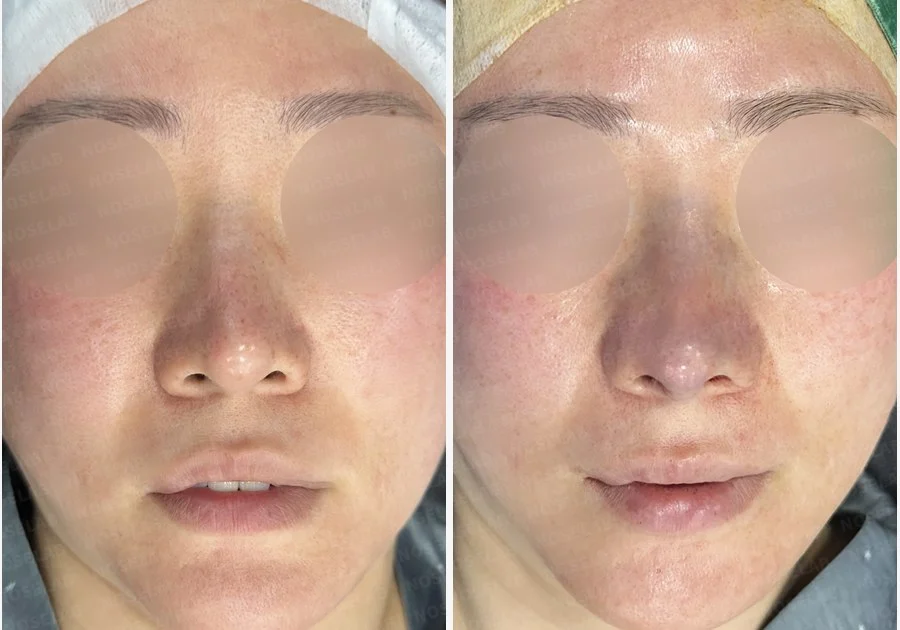 길고 처진 코 교정, 자가늑연골 비중격 재건과 콧대 보형물 교체로 완성한 코재수술 — 전후 비교